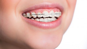 services - braces