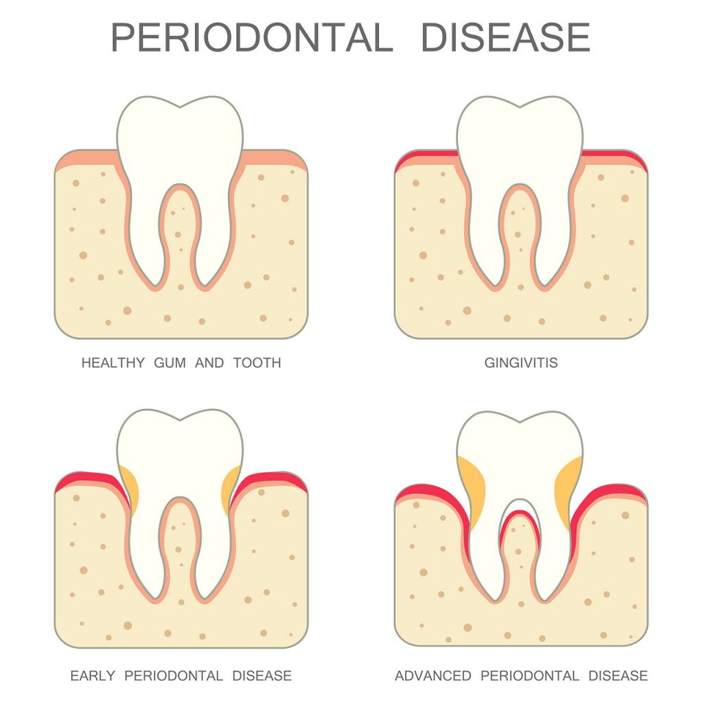 Gum Disease Treatment In Singapore, Teeth Cleaning Services - Lq Dental