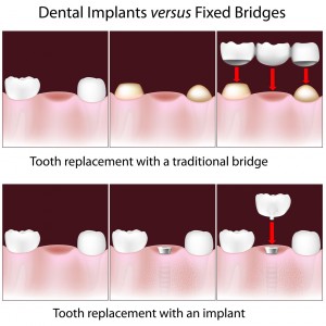 services - implant vs bridge