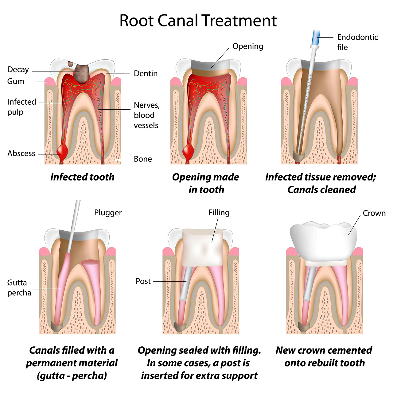 services - root canal treatment