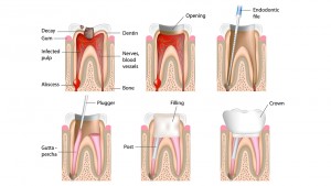 services - root canal treatment